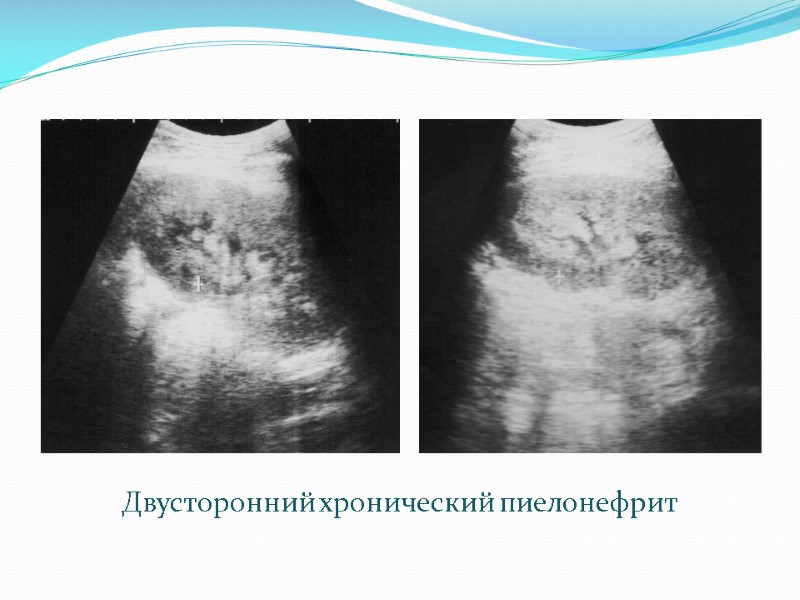 Двусторонний хронический пиелонефрит